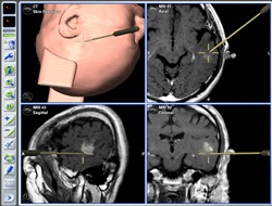 左側頭葉神経膠腫